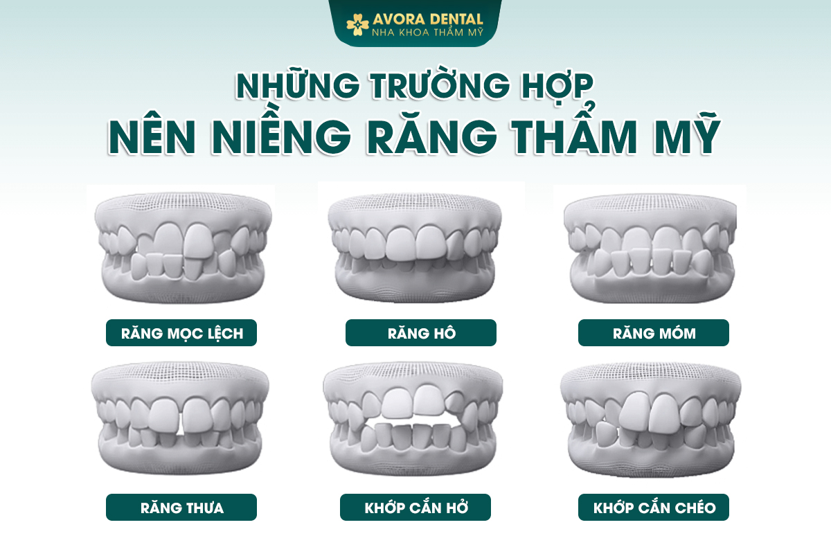 Niềng Răng Là Gì? Độ Tuổi Và Thời Gian Niềng Răng? Chi Phí Bao Nhiêu 2025?