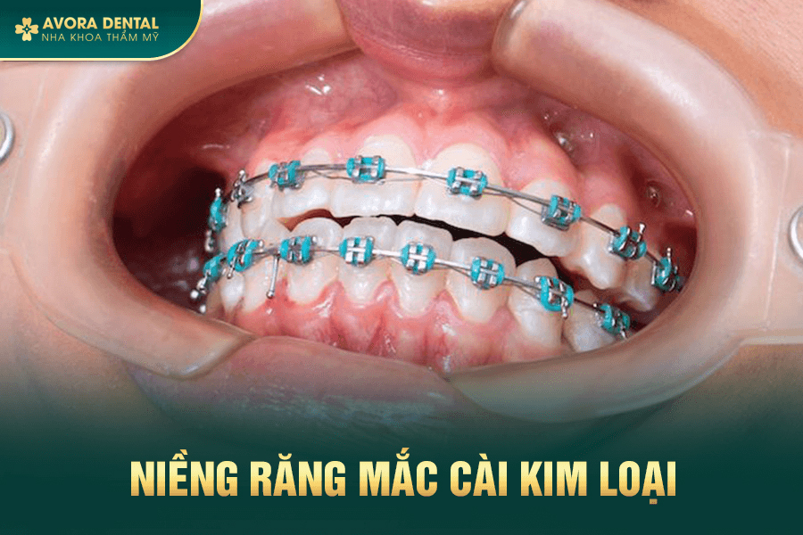 Niềng Răng Mắc Cài Kim Loại Là Gì? Có Tốt Không? Chi Phí Bao Nhiêu 2025